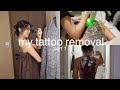 Tattoo Removal The Beginning Of My Tattoo Removal Journey