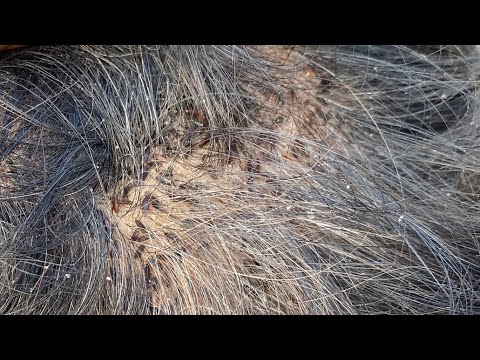 #licesremoval 🔥Head Lice Treatment – Wife Removes Lice from Husband | Love vs Lice EP 115🐜💇‍♀️