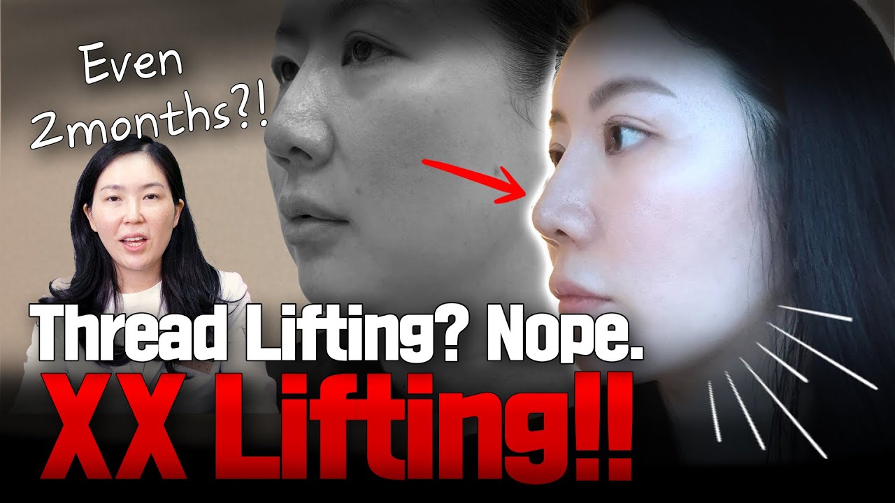 Viral lifting surgery real results before and after NANA Plastic Surgery Korea YouTube video