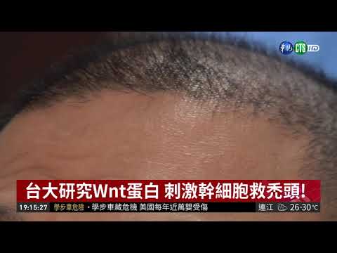 注射Wnt蛋白 刺激幹細胞救禿頭!