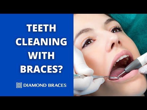 Can You Get Your Teeth Cleaned While Wearing Braces?