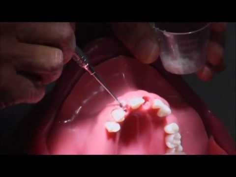 Dental implants Zimmer