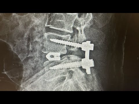 Effective Lumbar Spondylolisthesis Care for a 74-Year-Old | Dr. Ajay Kothari