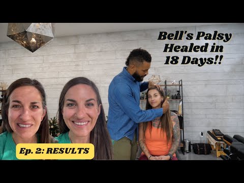Bell's Palsy COMPLETELY HEALED in 18 days with Chiropractic Care - Dr. Brett Jones Adjustments