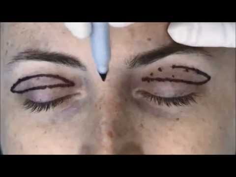 Markings for Upper Blepharoplasty