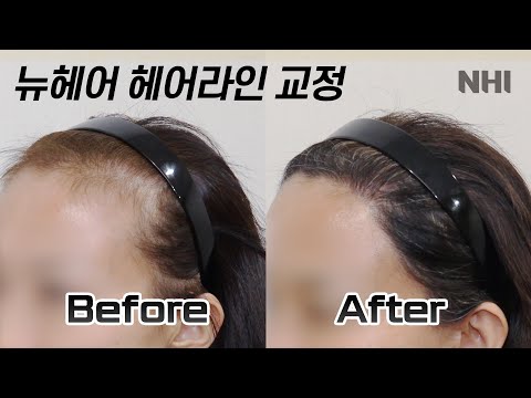 헤어라인교정 2000모낭(4000모) 1년 경과 I 뉴헤어 I Before&After [헤어라인][헤어라인교정]