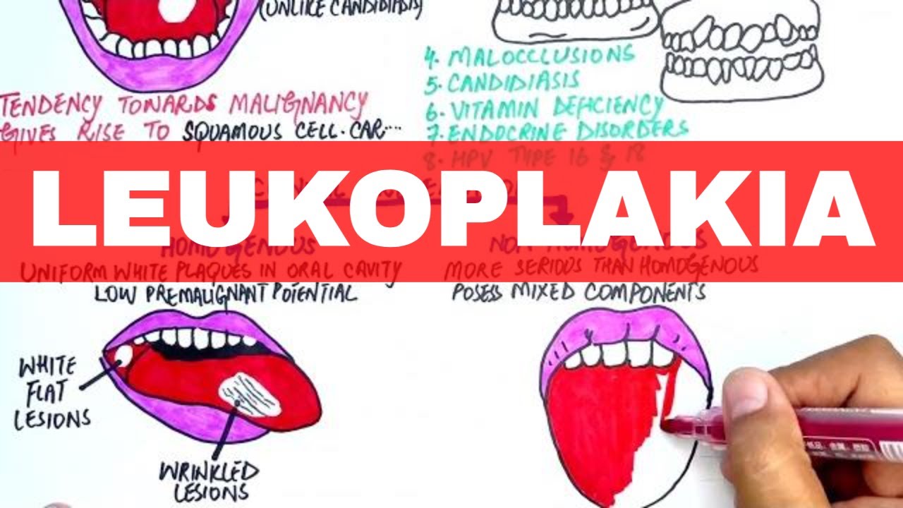 Leukoplakia - Causes, Diagnosis & Treatment