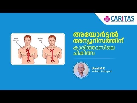 Treatment for aortic aneurysm at Caritas
