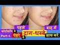 Photoshop मेंं चेहरे से Pimples और Dark Spots को Remove करें H
