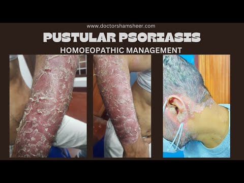 pustular psoriasis