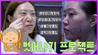 ★얼굴지방이식(이마, 앞광대), 얼굴지방흡입(볼, 이중턱) 수술전후!! ★제 1탄★