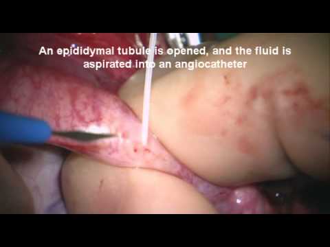 Microsurgical Epididymal Sperm Aspiration (MESA) 