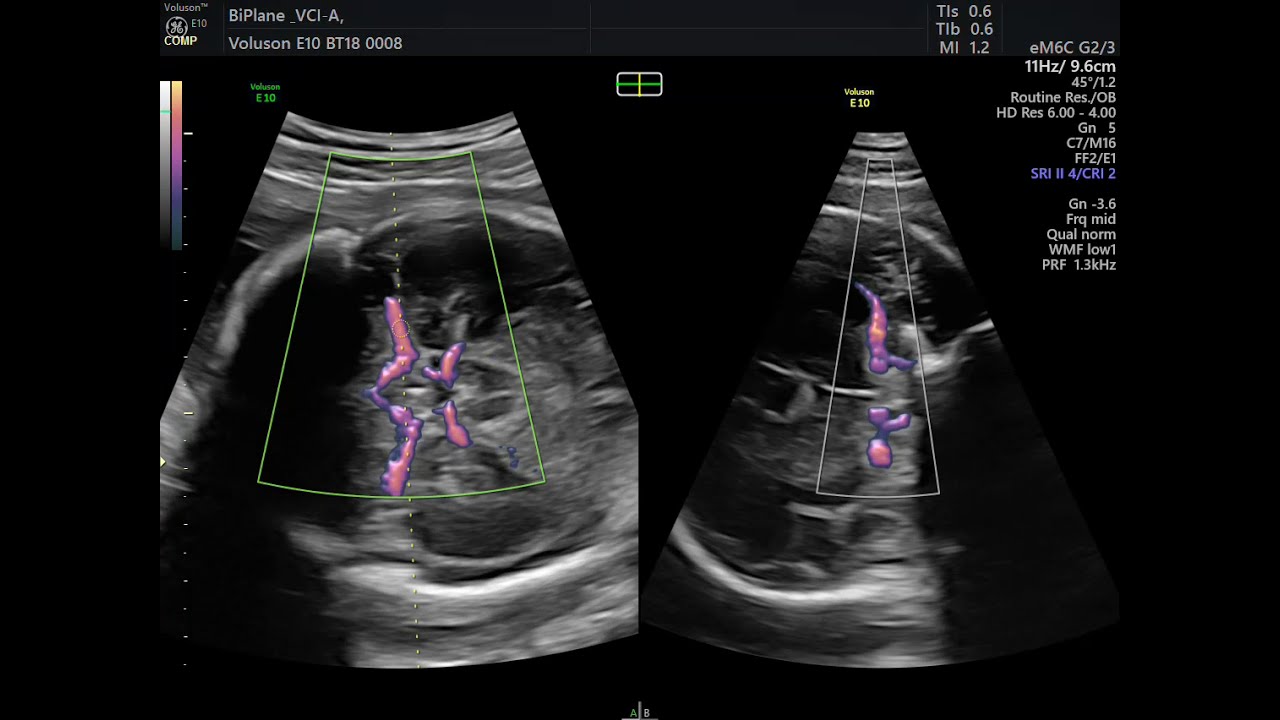 CIRCULAÇAO CEREBRAL FETAL
