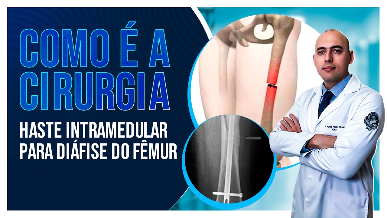 HASTE INTRAMEDULAR PARA DIÁFISE DO FÊMUR (anterógrada) | COMO É A CIRURGIA?