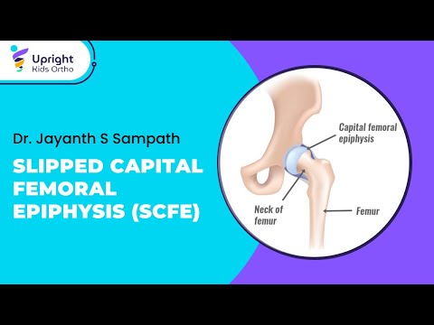 Slipped Capital Femoral Epiphysis (SCFE) | Best treatment for SCFE in Bangalore | Upright Kids Ortho