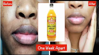 NATURALLY LIGHTEN DARK PIGMENTED LIPS QUICK❗️PERMANENT RESULTS IN 10 MINUTES ‼️ REAL PICTURES 2022