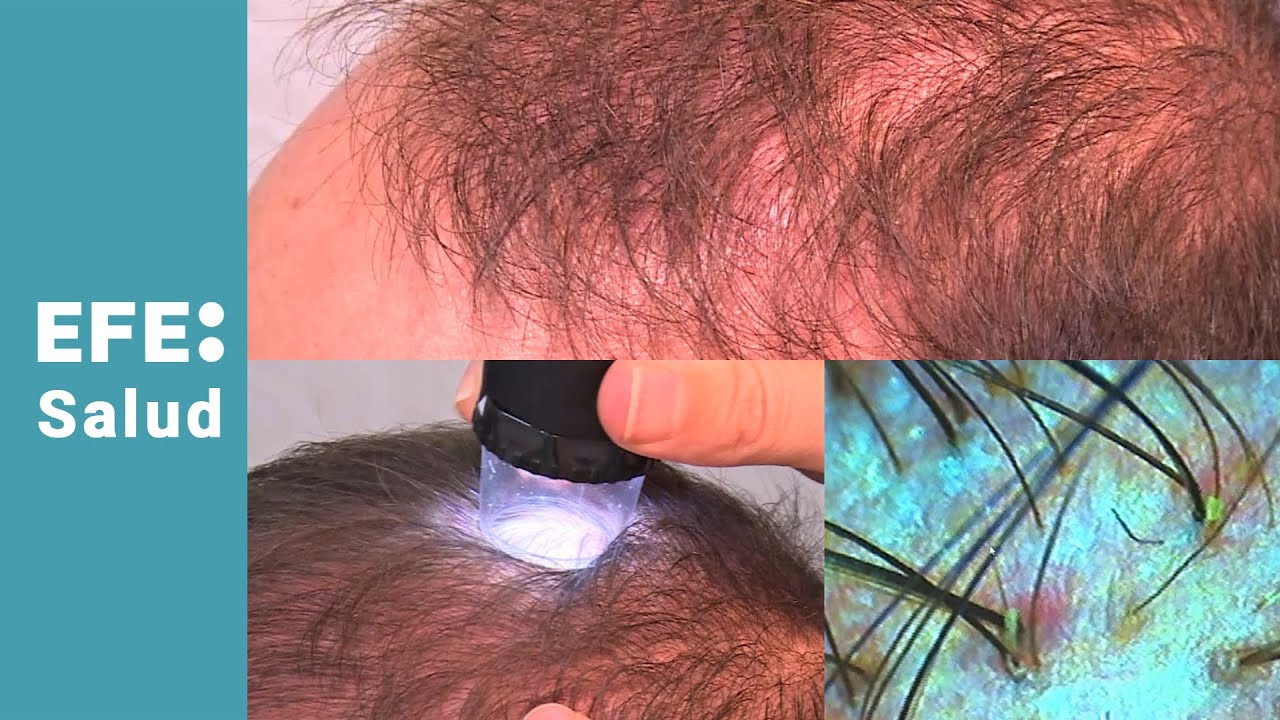 La tricoscopía, análisis real de tu calvicie