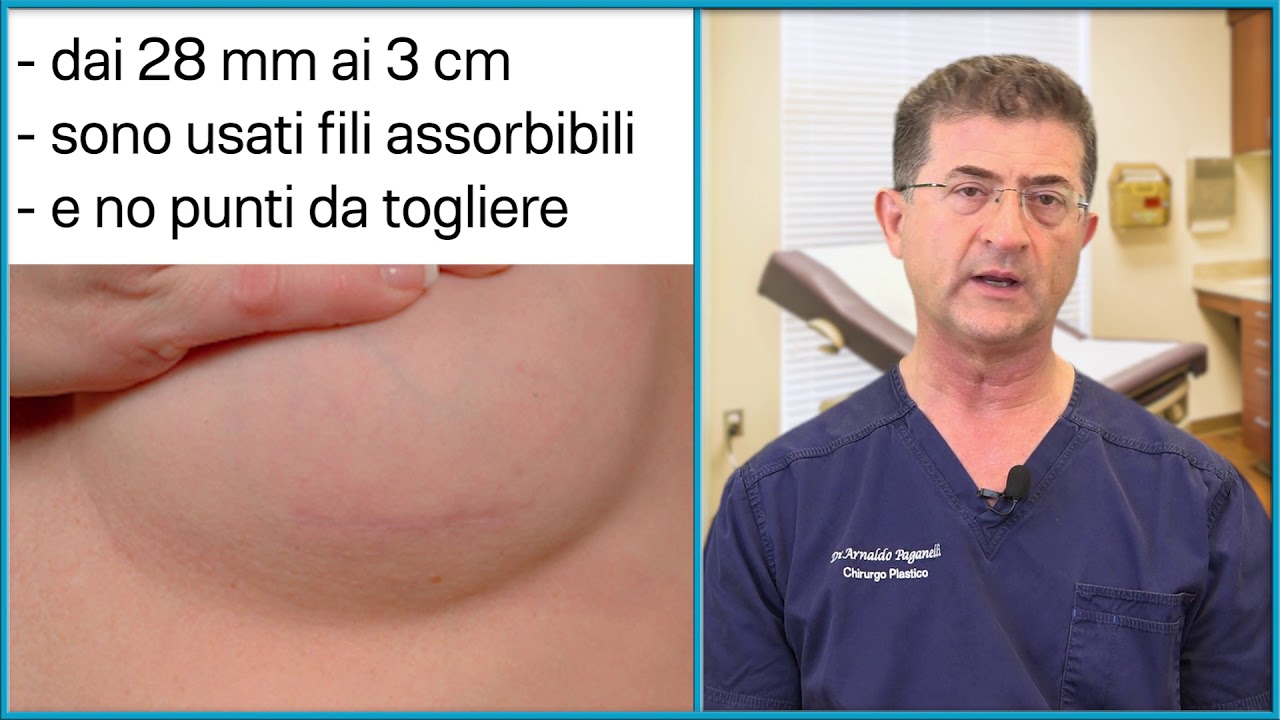 MASTOPLASTICA: Quanto sarà grande la cicatrice