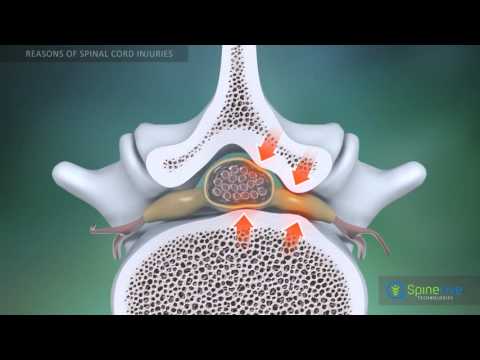 Spinal cord injury. Reasons