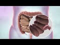 What is bowel cancer? | Cancer Research UK