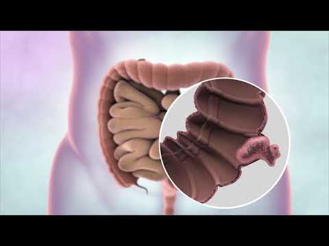 Hpv e cancer do colo do utero