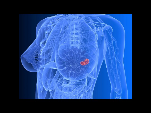 Мастопатия молочной железы: что это такое, как лечить эффективно