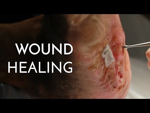 Wound Healing - Singapore Diabetic Foot Centre Video