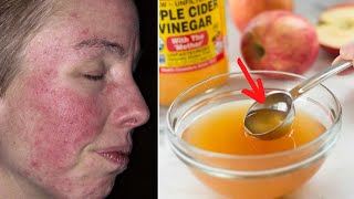 Natural remedy to get rid of rosacea permanently and naturally from face