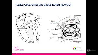 Common paediatric cardiac surgical operations – Dr Yishay Orr