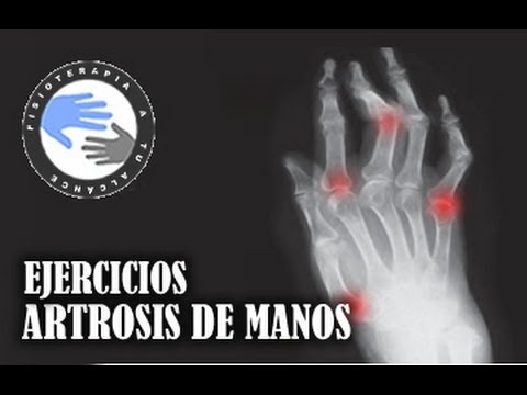 Cuántas sesiones Hirudotherapy necesario cuando osteocondrosis La implantación de la cirugía de endoprótesis de cadera
