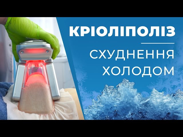 Фото 🧑‍⚕️ Чи можна схуднути в проблемних місцях без дієт та виснажливих фізичних вправ? Сучасні технології роблять можливим все, а головне – без жодних ризиків для Вашого здоров’я. 

🧬 Кріоліполіз — процедура охолодження підшкірно-жирового шару спеціальною вакуумною насадкою з подальшим руйнуванням жирових клітин. Дану технологію називають безопераційною ліпосакцією, що цілком виправдано результатами.