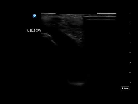 Elbow Ultrasound: Joint Effusion Long Axis 2