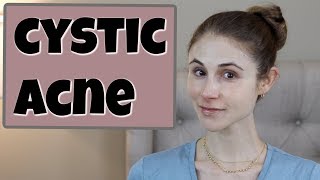 CYSTIC ACNE Q&A| DR DRAY