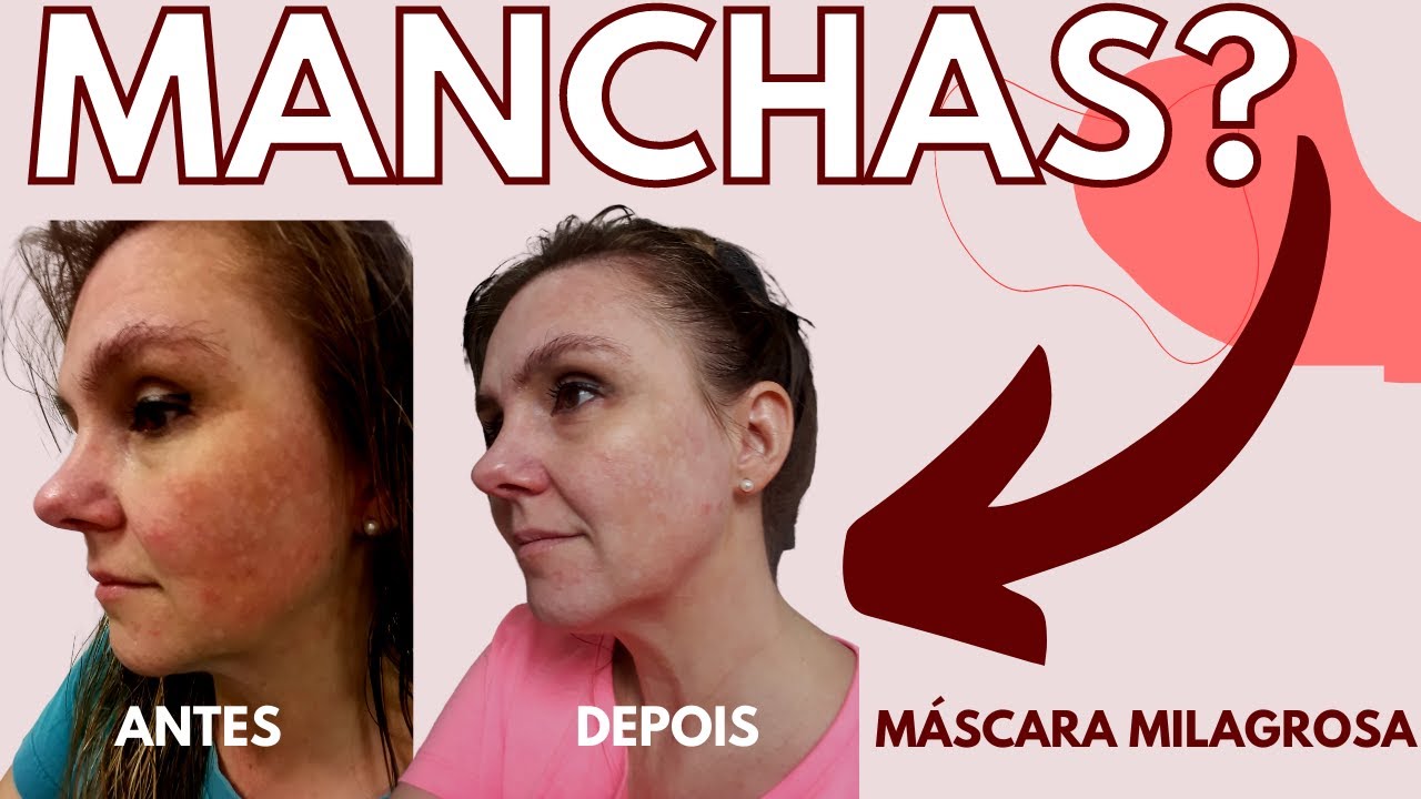 📢🆕🔝ACABE COM AS MANCHAS NA PELE E MELASMA #skincare #melasma #drarosanalahr #dermatologia