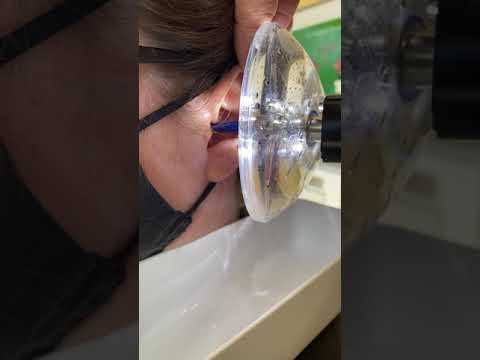 Removing Ear Wax using The Earigator™ at Hearing HealthCare Centers, Boulder, CO