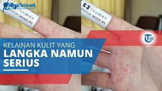 Stevens–Johnson Syndrome, Kelainan Kulit yang Langka Namun Serius dan Bisa Menyebabkan Kematian