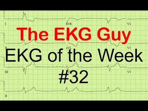 EKG/ECG of the Week #32 | The EKG Guy - www.ekg.md