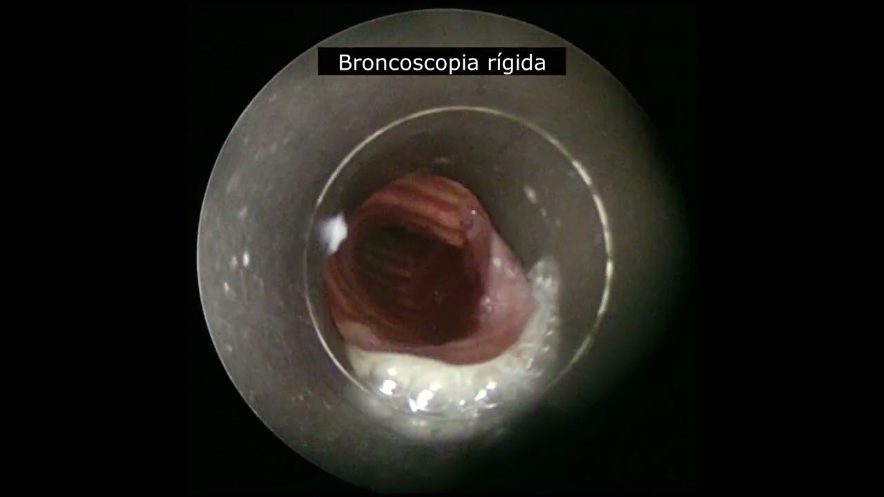 Tratamiento broncoscópico de fistula broncoesofágica con stent.