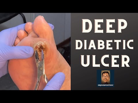 Diabetikus megálló kezelése lábujjak cukorbetegség