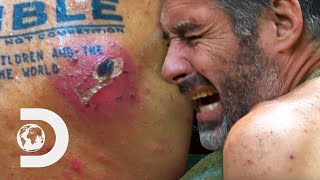 Necrotic Mosquito Bite Has To Be Removed Before This Man&#39;s Flesh Is Eaten | Naked And Afraid: Alone