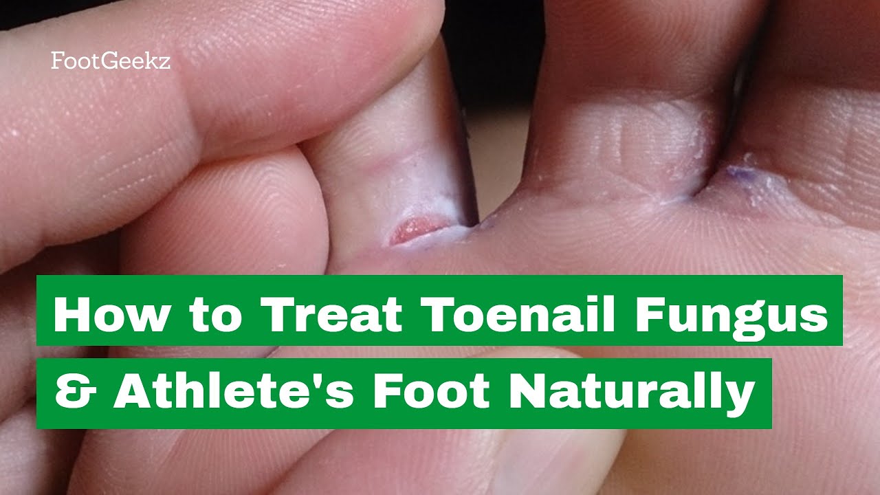 How to Treat Toenail Fungus & Athlete's Foot Naturally