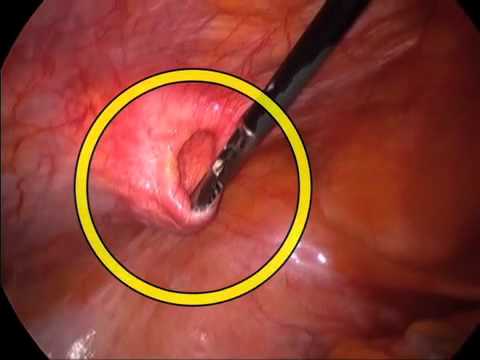 Small Spigelian Hernia - Laparoscopic Suture Repair