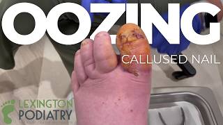 Oozing Callused Ingrown