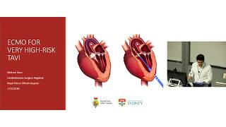 ECMO for Very High-Risk TAVI – Dr Michael Seco