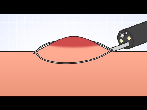 腹腔鏡検査 - 定義