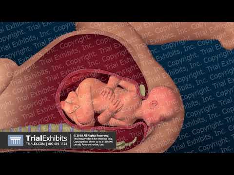 Maneuvers to Release Shoulder Dystocia