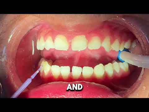 How do they put braces on? - 15 year old patient - Tooth Time Family Dentistry New Braunfels Texas