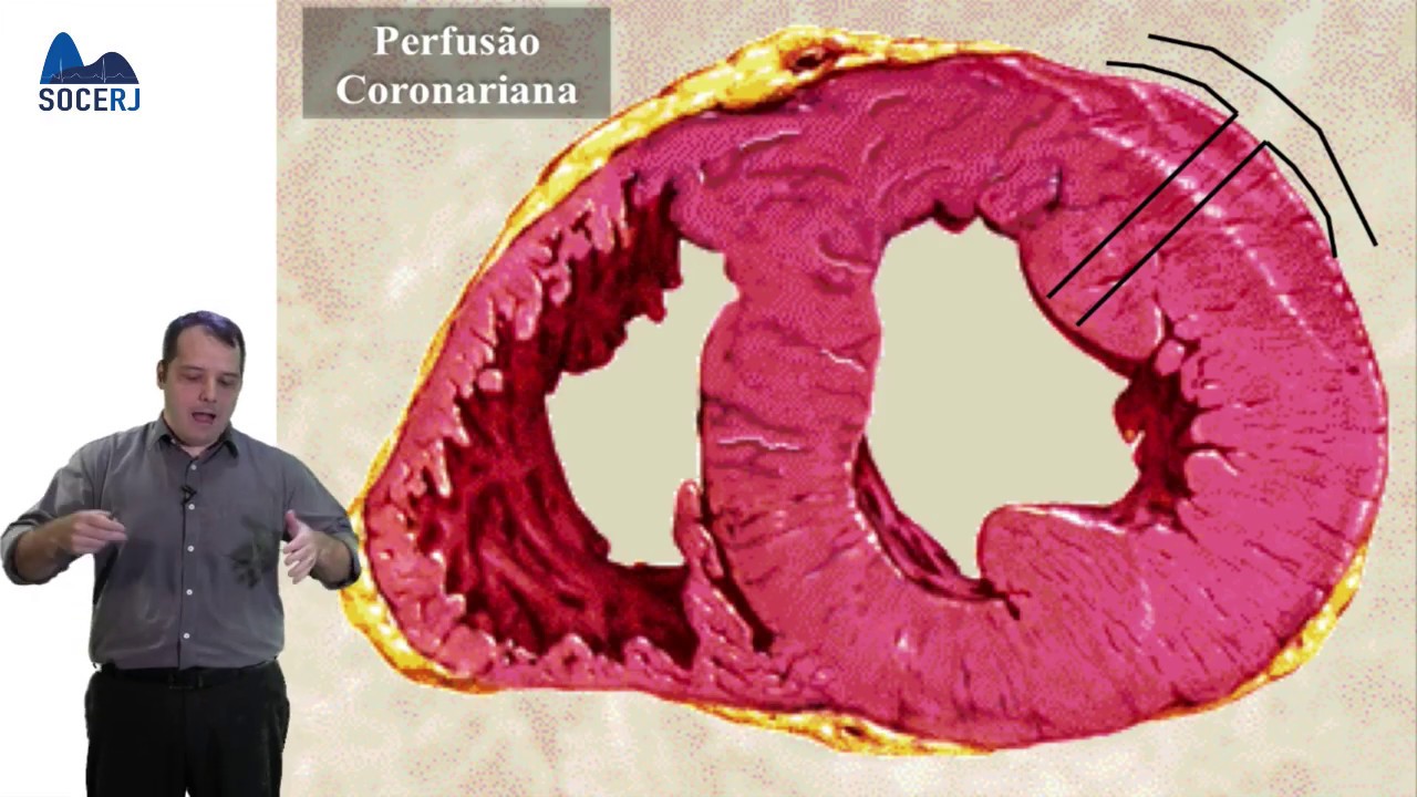 Curso Básico de ECG - Aula 06:  Distúrbios da Perfusão Miocárdica