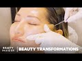 How Nonsurgical Face-Lifts Work With PDO Threads | Beauty Transformations | Insider Beauty