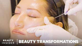How Nonsurgical Face-Lifts Work With PDO Threads | Beauty Transformations